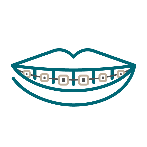 a graphic showing ceramic braces on a smile