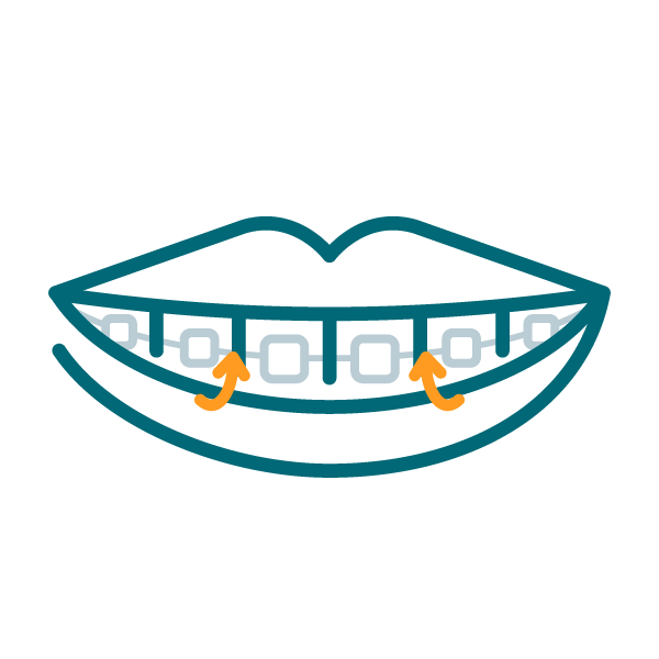 a graphic with braces on teeth with an arrow pointing between teeth
